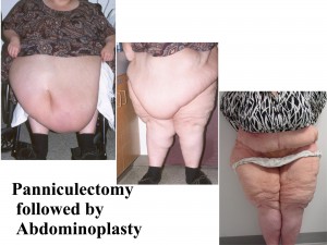 Abdominoplasty vs. Panniculectomy - Dr. Michael Kreidstein