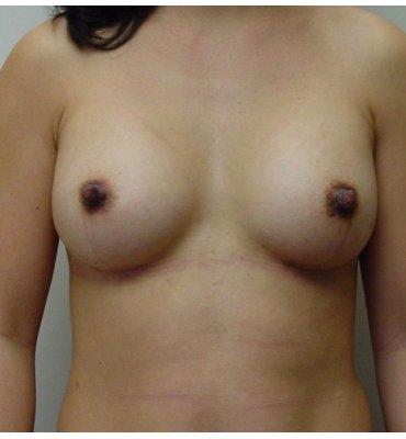 370px x 400px - Breast Augmentation Before & After Photo Gallery | Dr. Michael Kreidstein