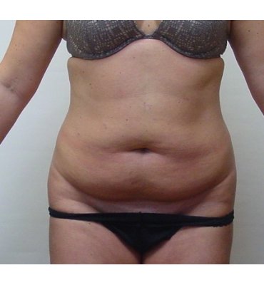 Tummy Tuck Scars Before and After Photo Gallery