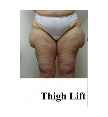 Thigh Lift Before & After Pictures Nashville, Franklin, TN