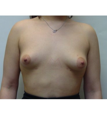 Breast Augmentation Before & After Photo Gallery | Dr. Michael Kreidstein