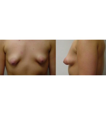 Tubular Breast Porn - Breast Augmentation Before & After Photo Gallery | Dr. Michael Kreidstein