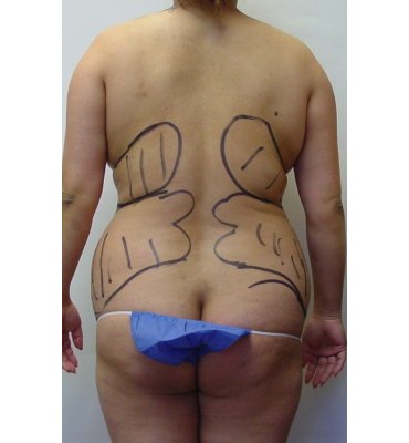 Liposuction Before & After Photo Gallery