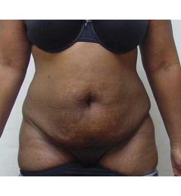 Abdominoplasty Before & After Photo Gallery