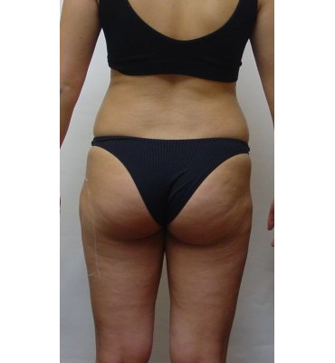 SmartLipo Toronto Before & After Gallery